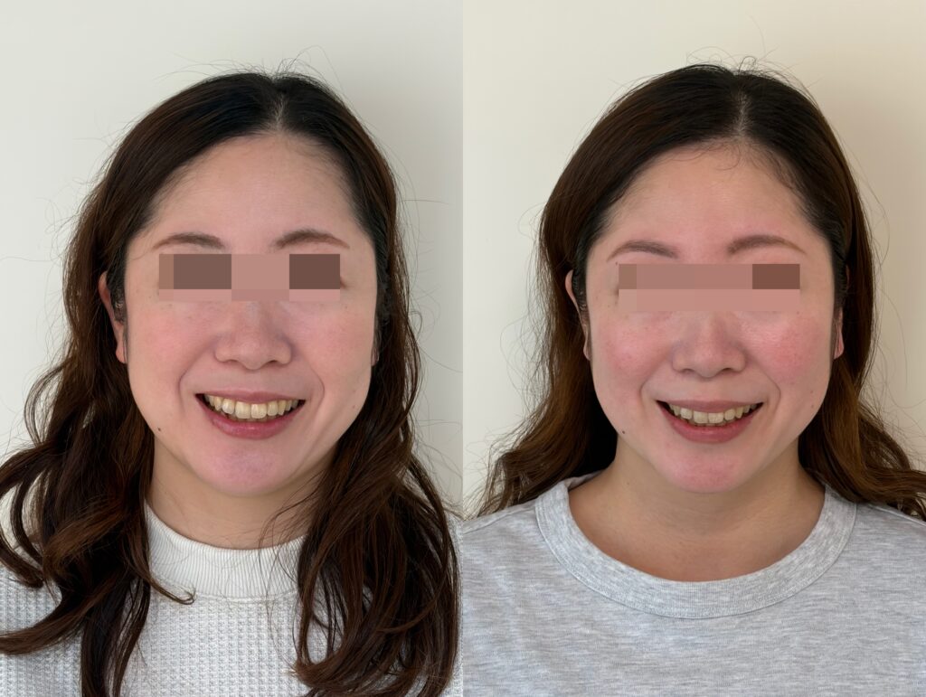 小顔矯正サンプル