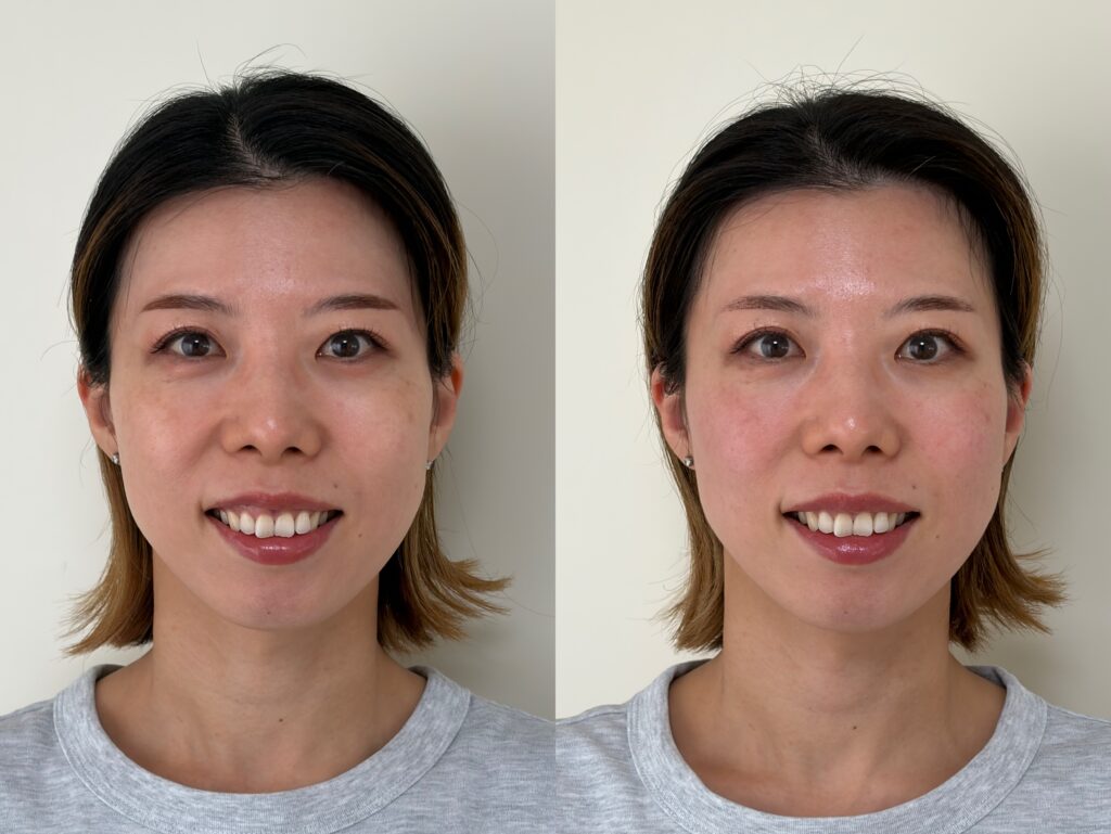 小顔矯正サンプル