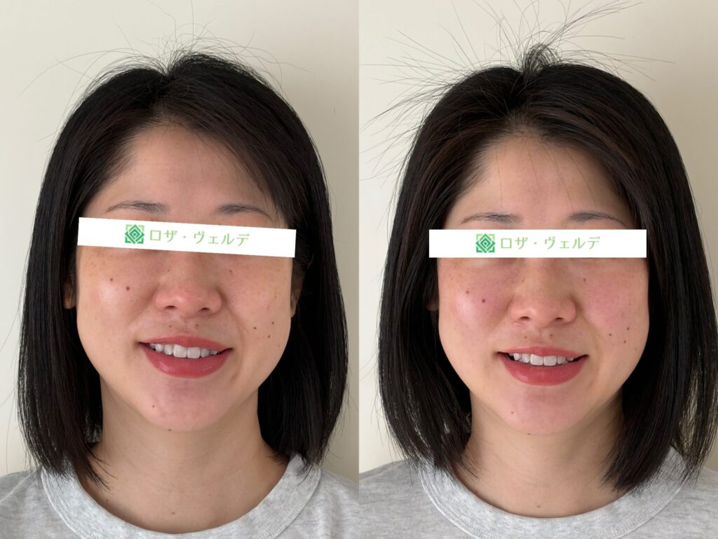 小顔矯正サンプル