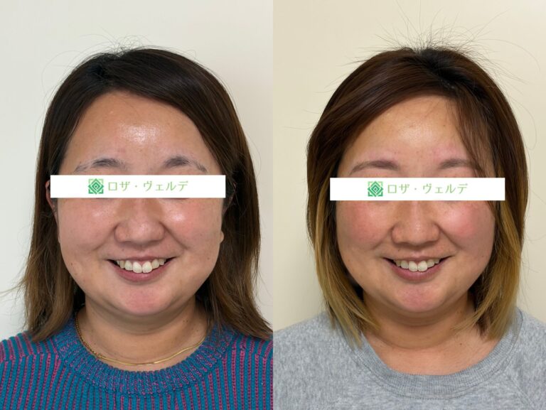 小顔矯正のビフォーアフター