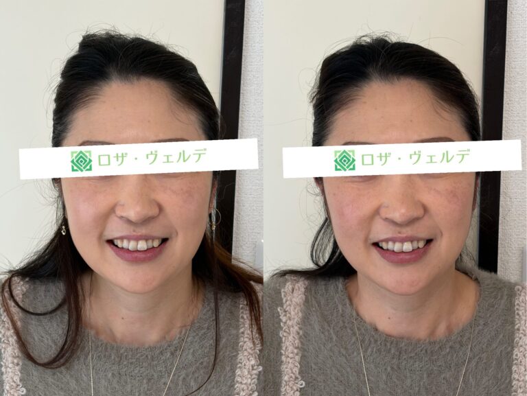 小顔矯正のビフォーアフター
