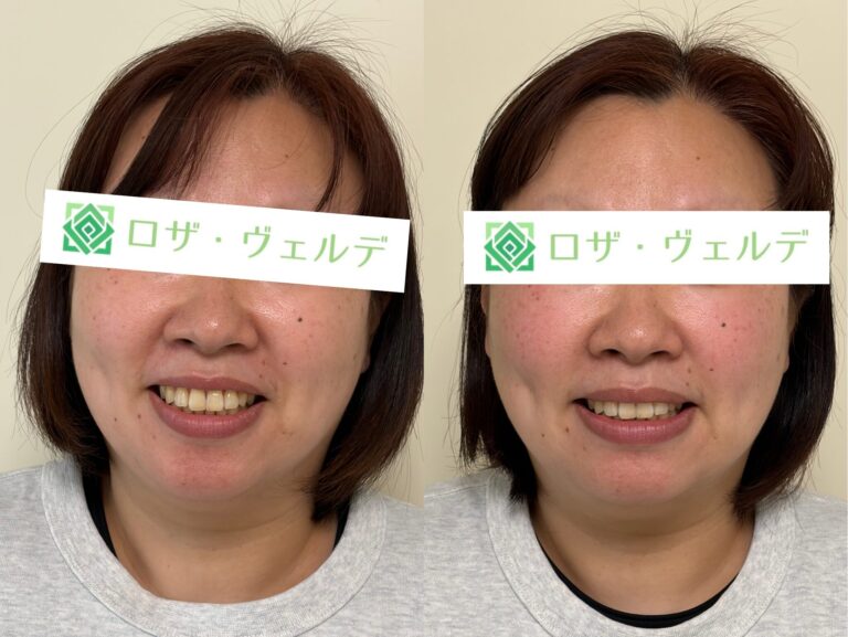 小顔矯正のビフォーアフター